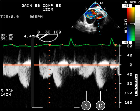 pulse wave spectral doppler of Mitral Valve