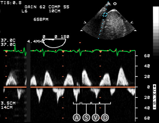 pulse wave spectral doppler of Mitral Valve