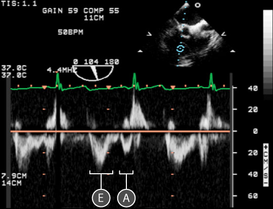 pulse wave spectral doppler of tricuspid Valve